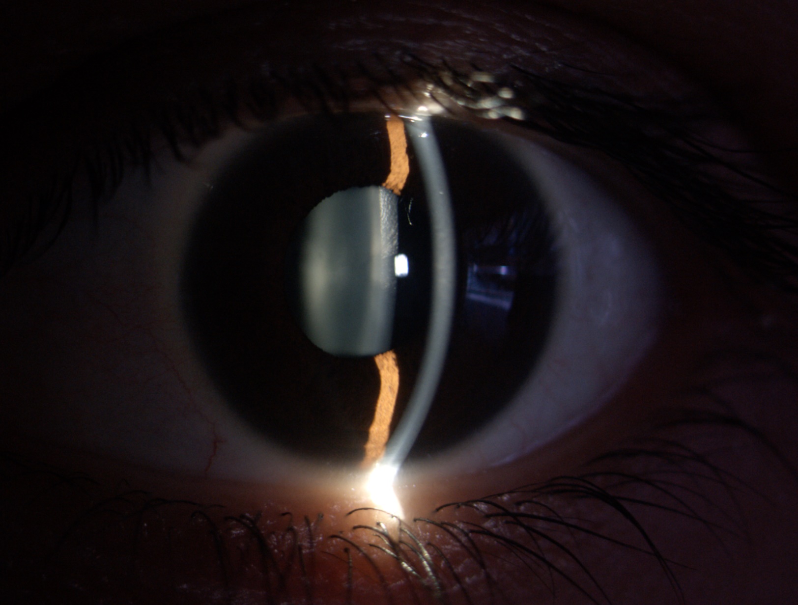 Cataract